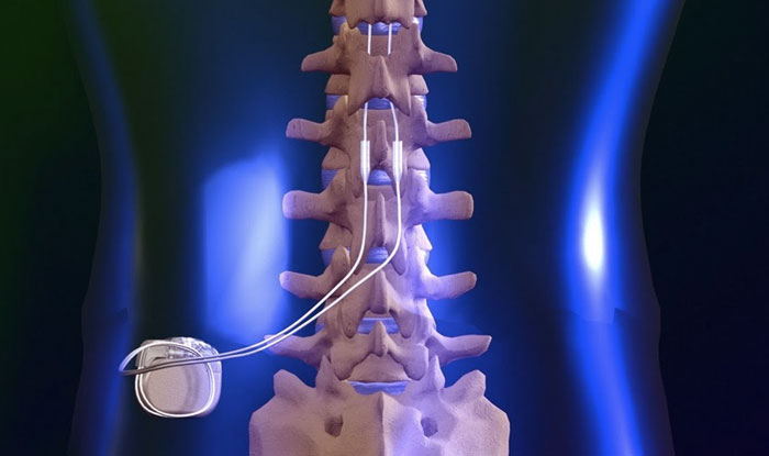 Read more about the article Spinal Cord Stimulator