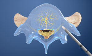 basal-vertebral-nerve-ablation