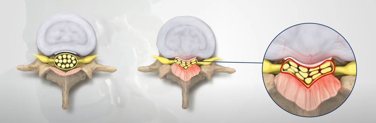 Read more about the article Minimally Invasive Lumbar Decompression (MILD)