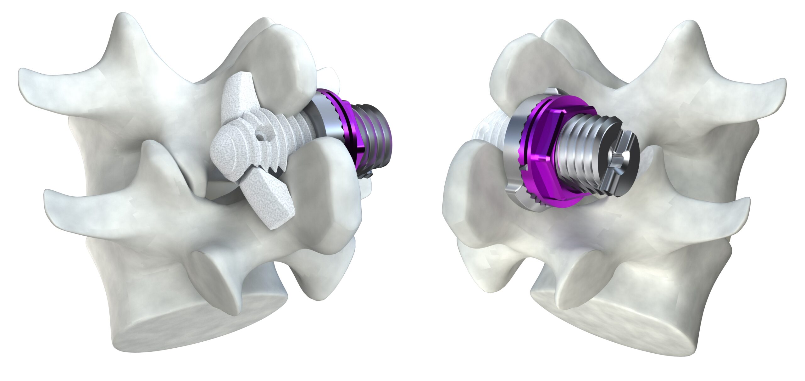minuteman - minimally invasive spinal fusion - featured