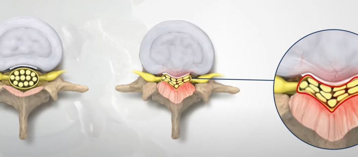 MILD-Minimally-Invasive-Lumbar-Decompression