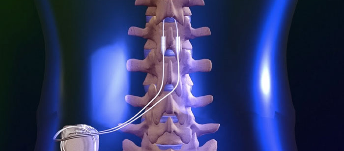 RPC_Spinal_Cord-Stimulator_Overview
