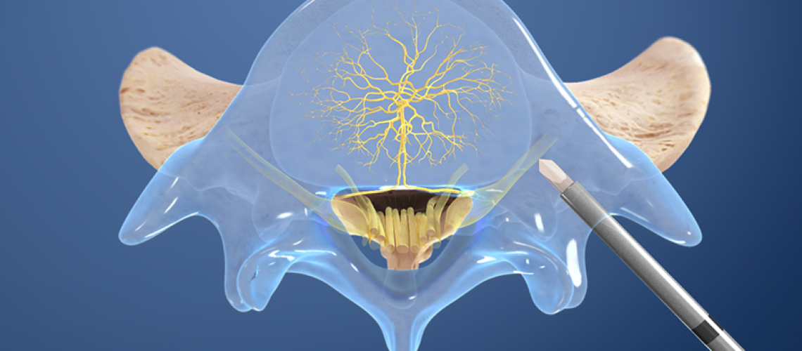 basal-vertebral-nerve-ablation